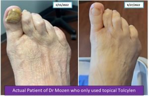 nail fungus treatment