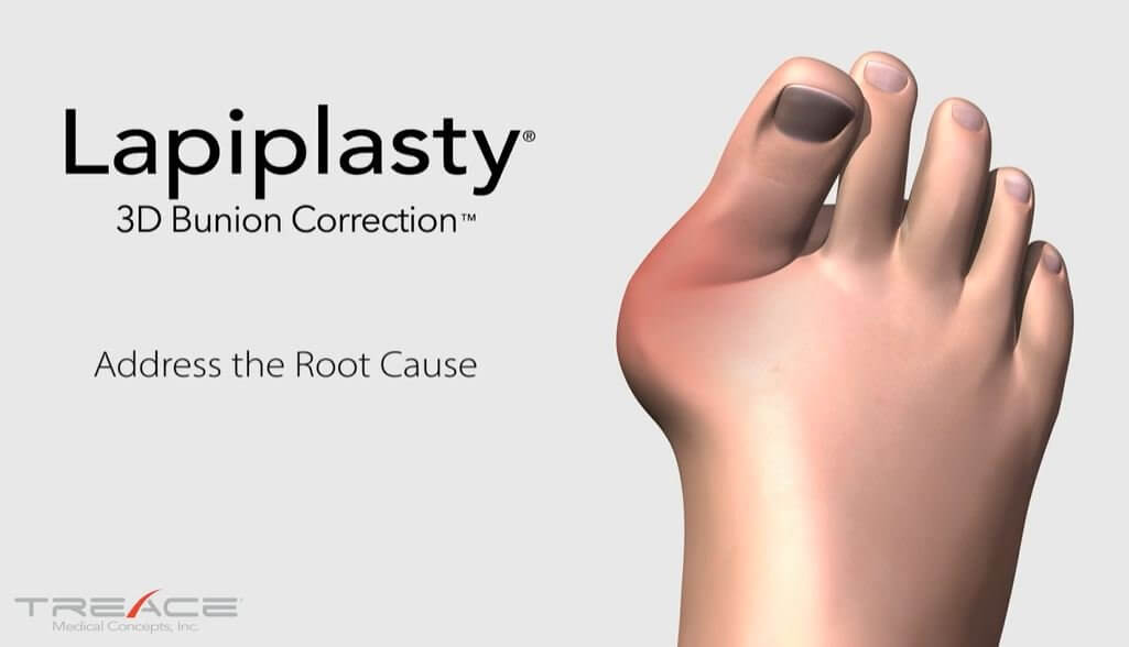 Lapiplasty lapiplasty bunion surgery